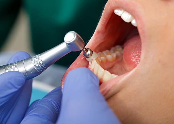 Dental Bonding in Westminster, CA